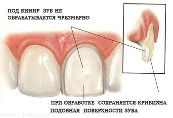 Установка винира