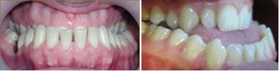 Mesial occlusion Мезиальный прикус