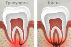 причины образования кисты, киста