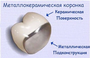 Металлокерамические коронки