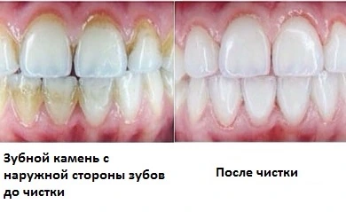 Зубной камень с наружной стороны зубов