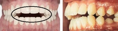 Open bite Открытый прикус