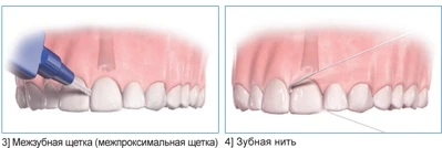 Чистка при помощи зубной нити