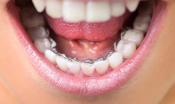Braces internal Брекеты внутренние