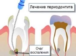 Лікування періодонтиту причини симптоми методи лікування