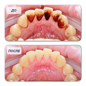 Результат после гигиенической чистки зубов 
