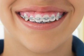 braces брекеты киев