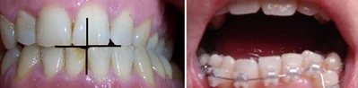 Crossbite Перекрестный прикус
