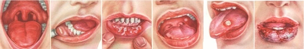 Специфика лечения стоматита