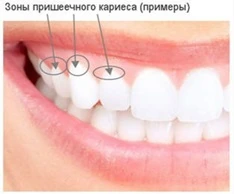 пришеечный кариес зубов
