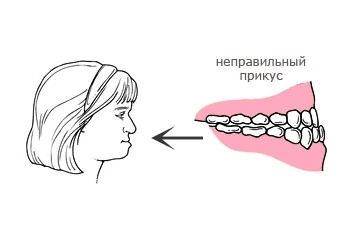 Неправильний прикус лікування причини