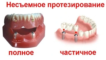 Fixed prosthetics несъемное протезирование киев