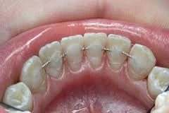 retainer Ретейнер