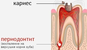 Кариес зубов