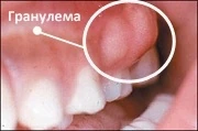 Гранулема зуба
