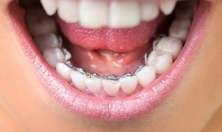 Braces in Kiev Брекеты в Киве