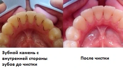 Зубной камень с внутренней стороны зубов