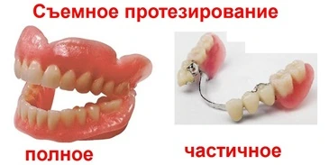 Removable prosthetics съемное протезирование киев