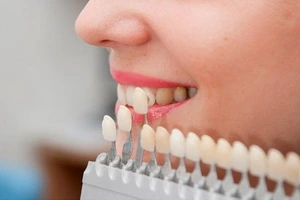 Керамічна реставрація зубів