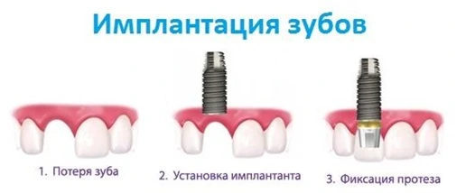 имплантация зубов киев