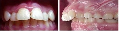 Distal bite Дистальный прикус