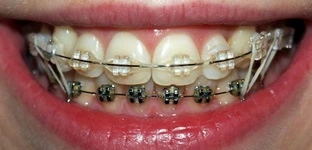 Bracket systems Брекет-системы
