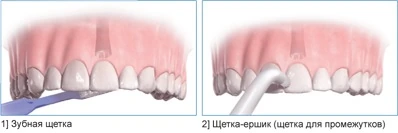 Чистка при помощи зубной щетки и специальной пасты