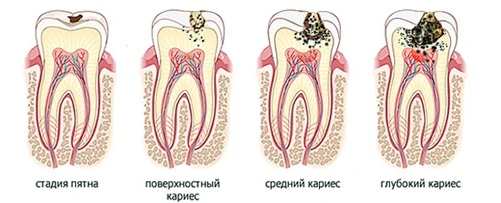 кариес зубов, кариес зубов киев, лечение кариеса зубов киев